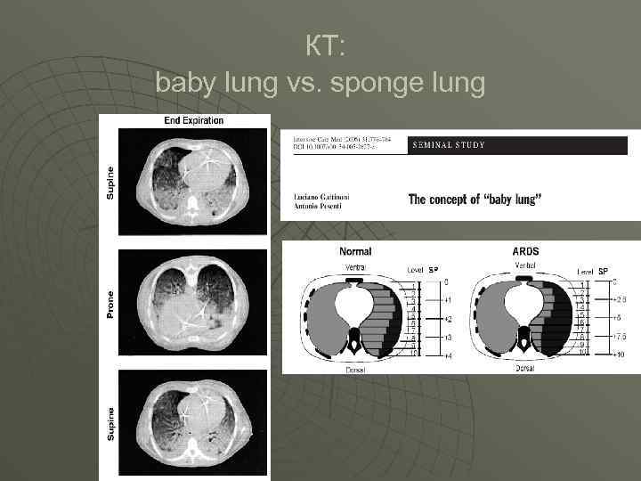  КТ: baby lung vs. sponge lung 