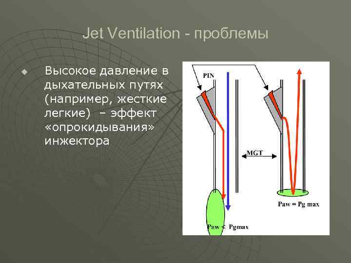  Jet Ventilation - проблемы u Высокое давление в дыхательных путях (например, жесткие легкие)