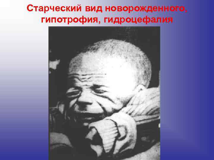 Старческий вид новорожденного, гипотрофия, гидроцефалия Старческий вид новорожденного, гипотрофия, гидроцефалия