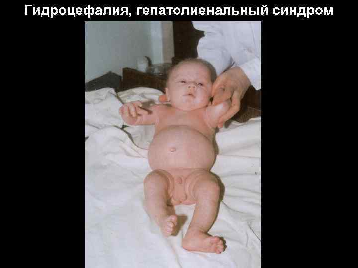 Гидроцефалия, гепатолиенальный синдром Гидроцефалия, гепатолиенальный синдром