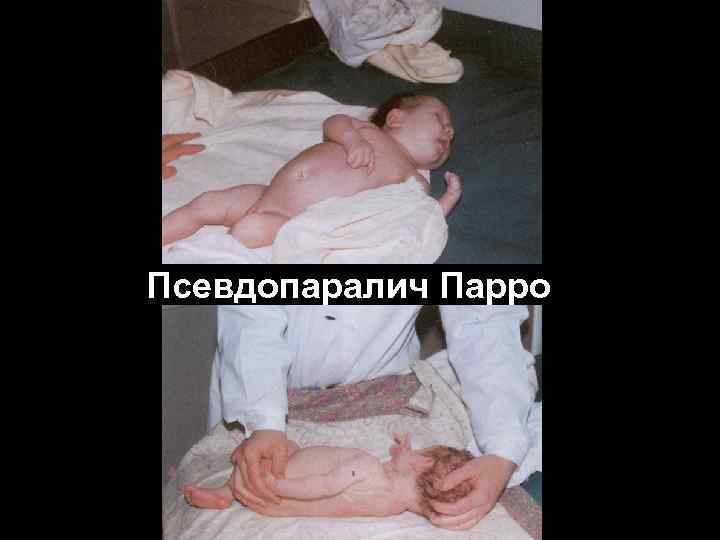 Псевдопаралич Парро Псевдопаралич Парро