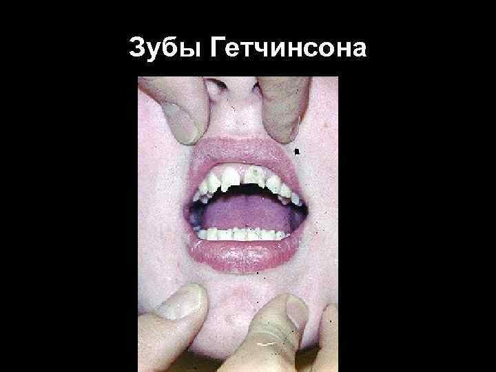 Зубы Гетчинсона Зубы Гетчинсона
