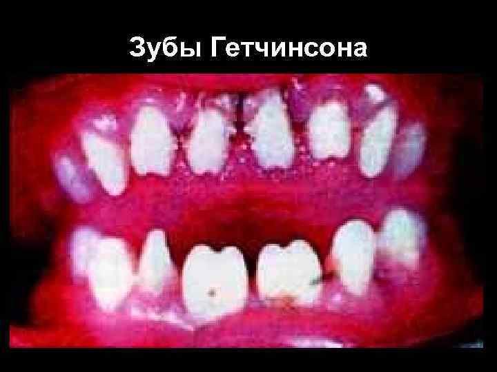 Зубы Гетчинсона Зубы Гетчинсона