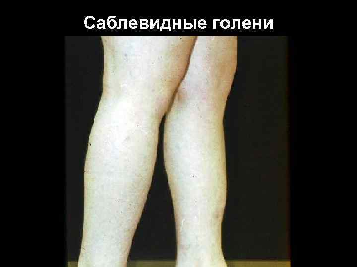 Саблевидные голени Саблевидные голени