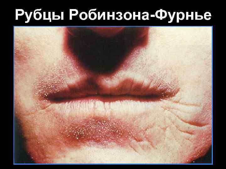 Рубцы Робинзона-Фурнье Рубцы Робинзона-Фурнье