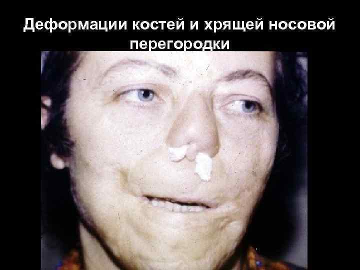Деформации костей и хрящей носовой перегородки Деформации костей и хрящей носовой перегородки