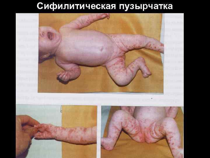 Сифилитическая пузырчатка Сифилитическая пузырчатка
