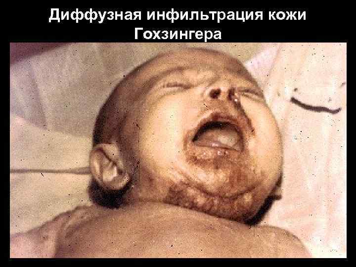 Диффузная инфильтрация кожи Гохзингера Диффузная инфильтрация кожи Гохзингера