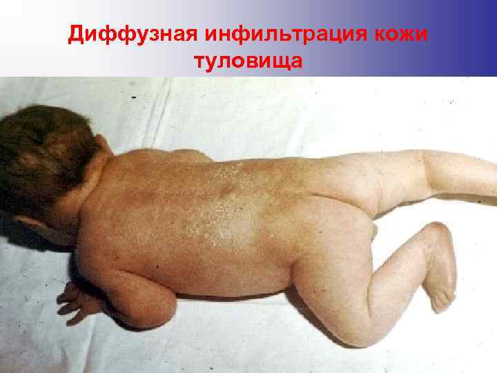 Диффузная инфильтрация кожи туловища Диффузная инфильтрация кожи туловища