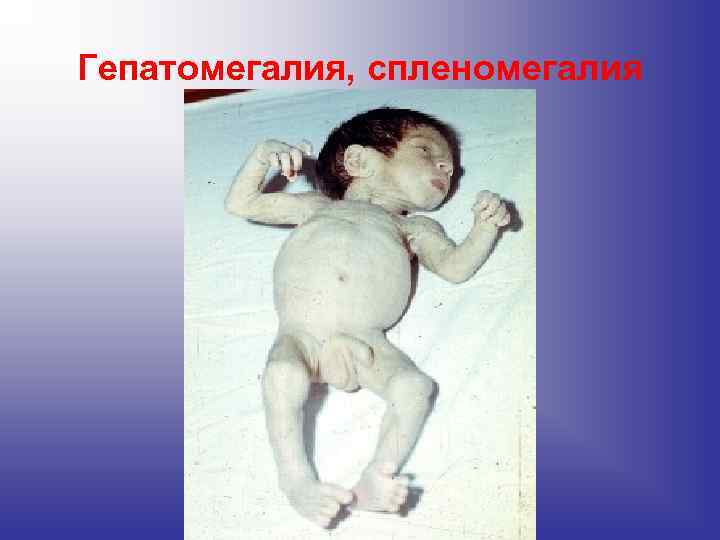 Гепатомегалия, спленомегалия Гепатомегалия, спленомегалия