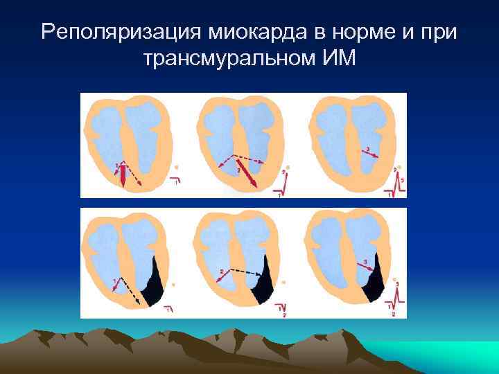 Реполяризация миокарда в норме и при трансмуральном ИМ 
