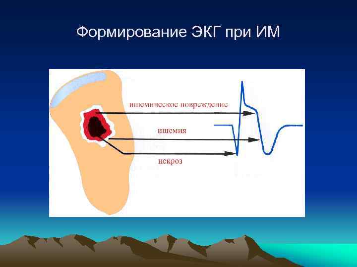 Формирование ЭКГ при ИМ 