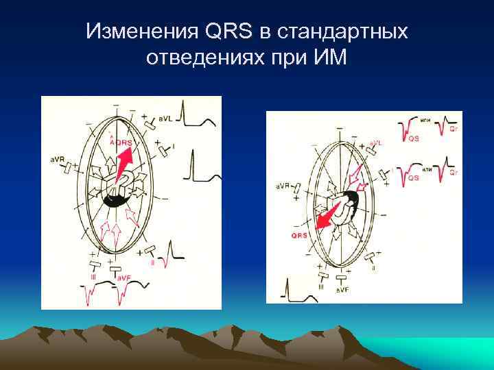 Изменения QRS в стандартных отведениях при ИМ 