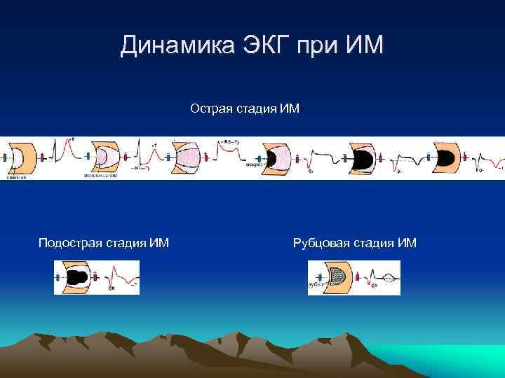 Динамика ЭКГ при ИМ Острая стадия ИМ Подострая стадия ИМ Рубцовая стадия ИМ 
