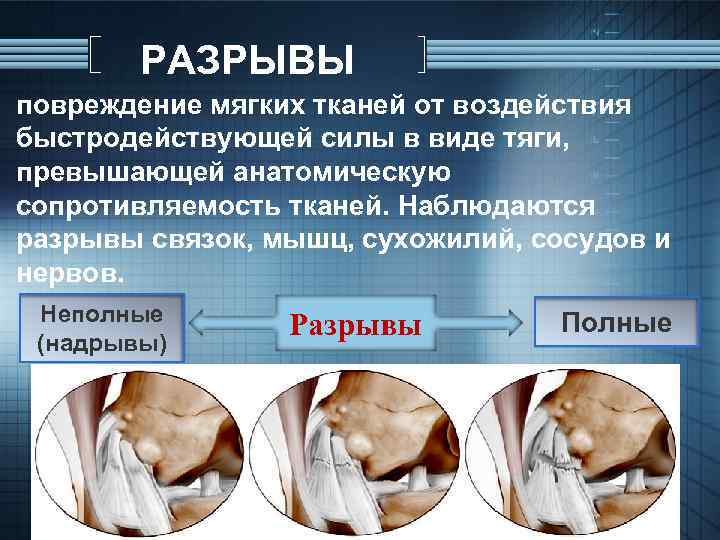 РАЗРЫВЫ повреждение мягких тканей от воздействия быстродействующей силы в виде тяги, превышающей анатомическую сопротивляемость