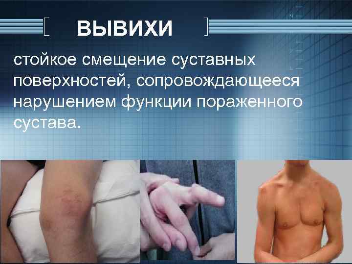 ВЫВИХИ стойкое смещение суставных поверхностей, сопровождающееся нарушением функции пораженного сустава. 
