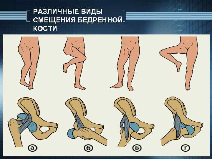 РАЗЛИЧНЫЕ ВИДЫ СМЕЩЕНИЯ БЕДРЕННОЙ КОСТИ 