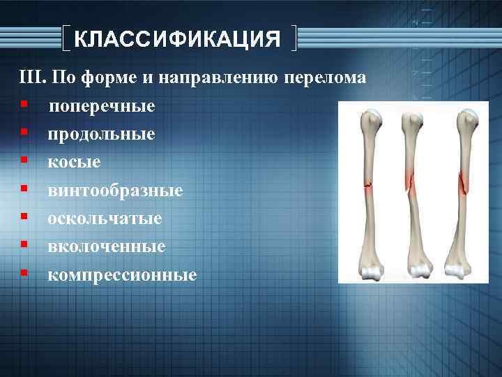 КЛАССИФИКАЦИЯ ІІІ. По форме и направлению перелома § поперечные § продольные § косые §