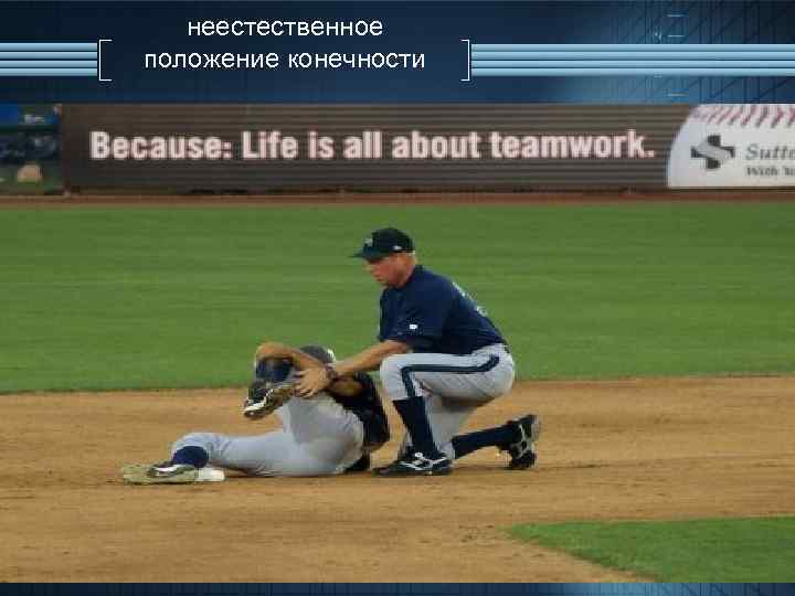 неестественное положение конечности 