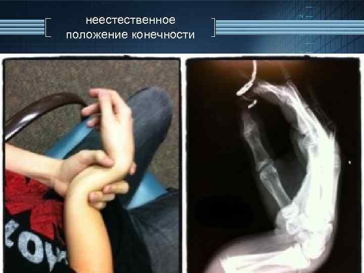 неестественное положение конечности 