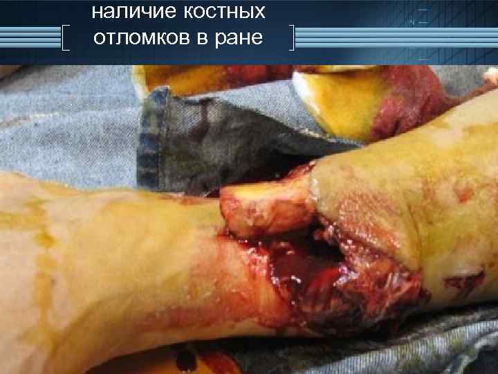 наличие костных отломков в ране 