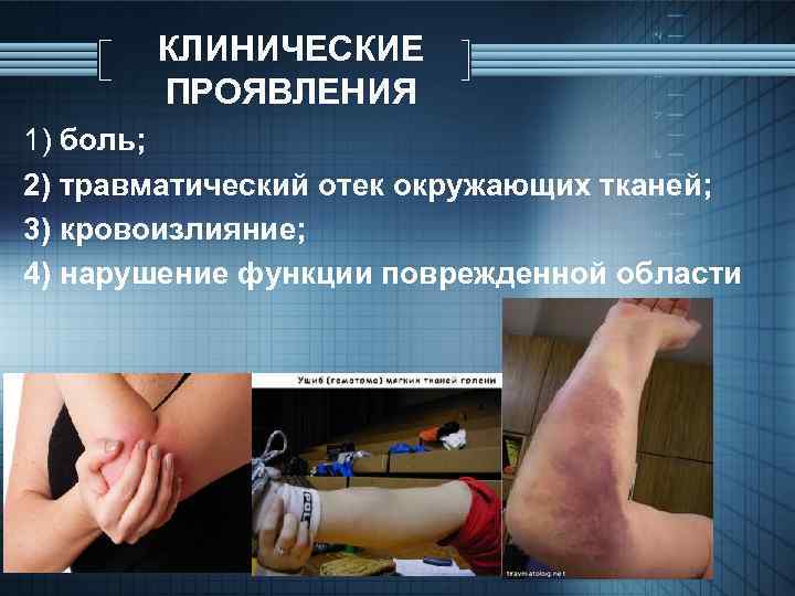 КЛИНИЧЕСКИЕ ПРОЯВЛЕНИЯ 1) боль; 2) травматический отек окружающих тканей; 3) кровоизлияние; 4) нарушение функции