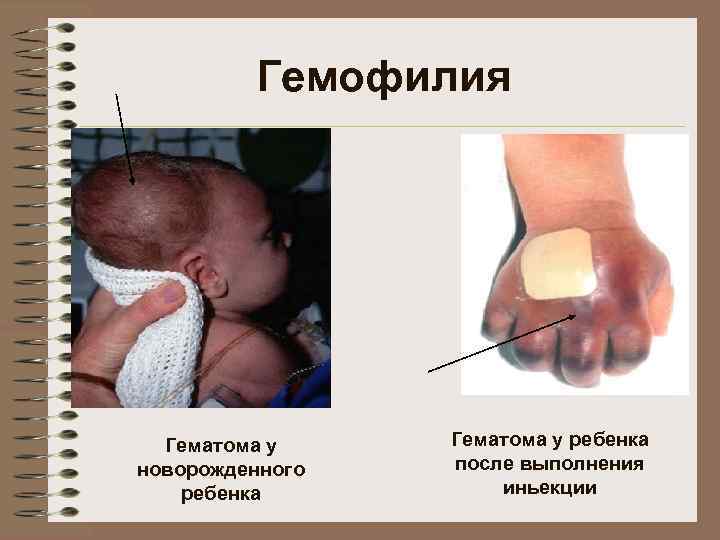 Гемофилия Гематома у новорожденного ребенка Гематома у ребенка после выполнения иньекции 