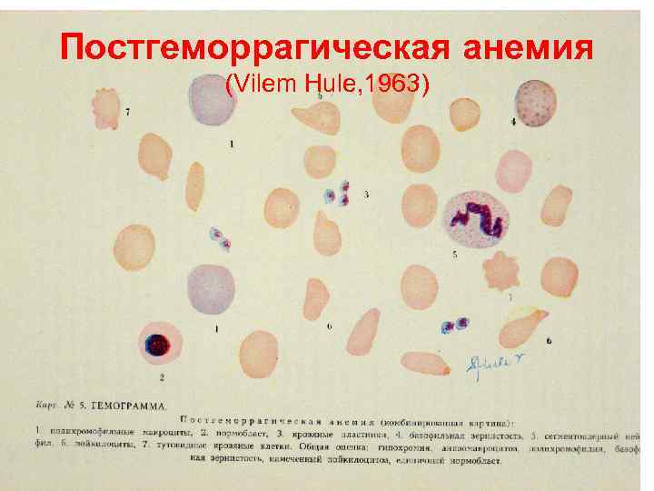 Постгеморрагическая анемия (Vilem Hule, 1963) 