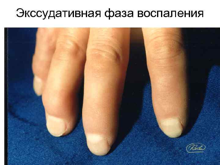 Экссудативная фаза воспаления 