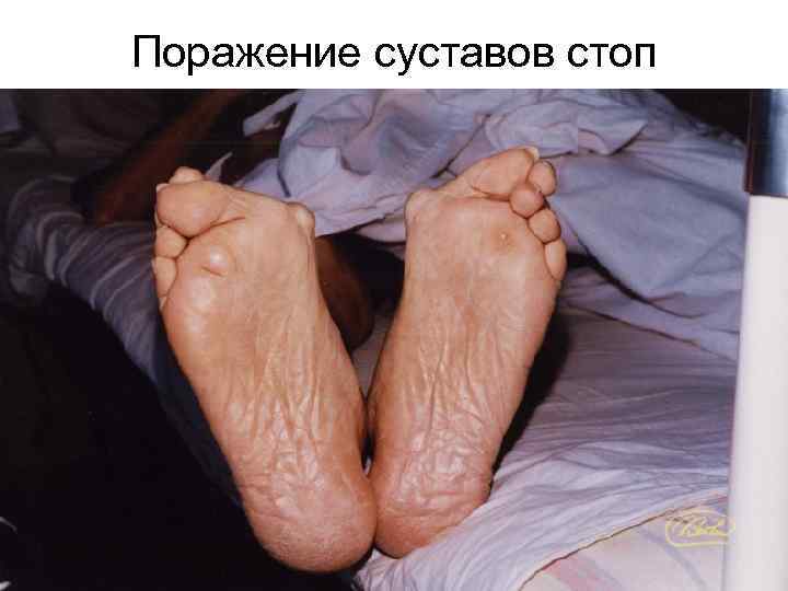 Поражение суставов стоп 