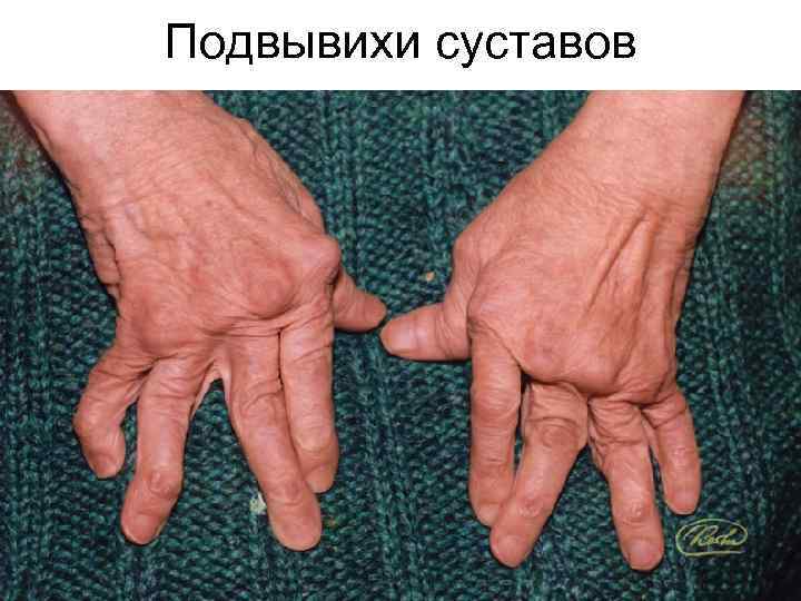 Подвывихи суставов 
