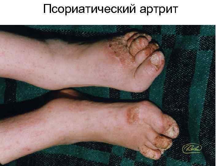 Псориатический артрит 