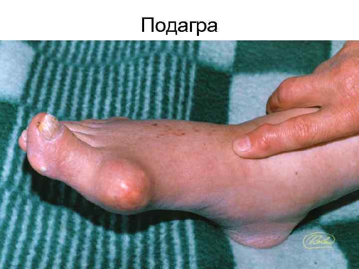 Подагра 