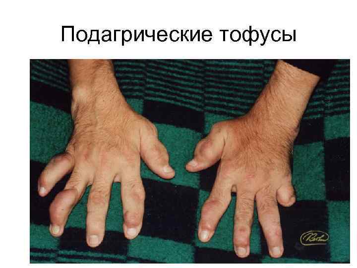 Что такое тофусы фото