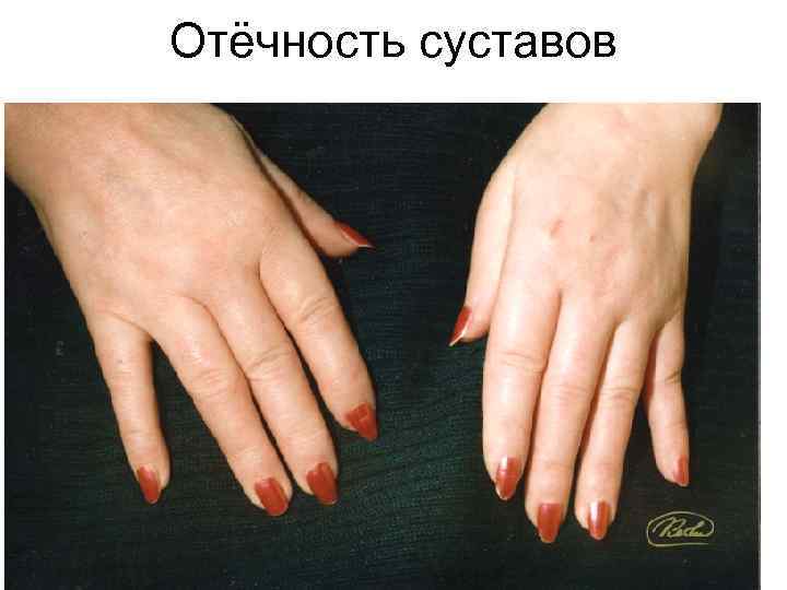 Отёчность суставов 