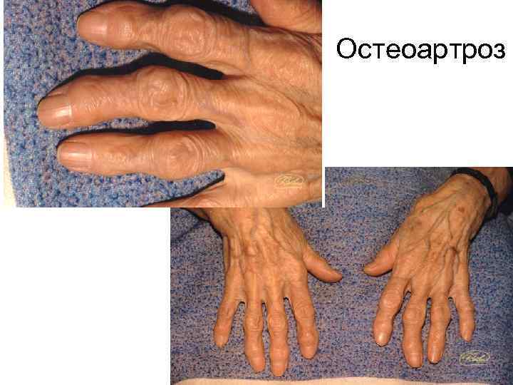 Остеоартроз 