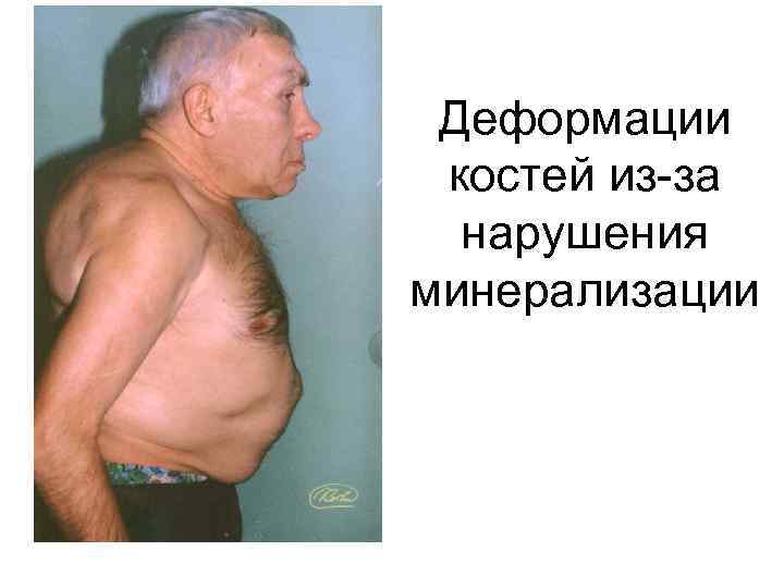 Деформации костей из-за нарушения минерализации 