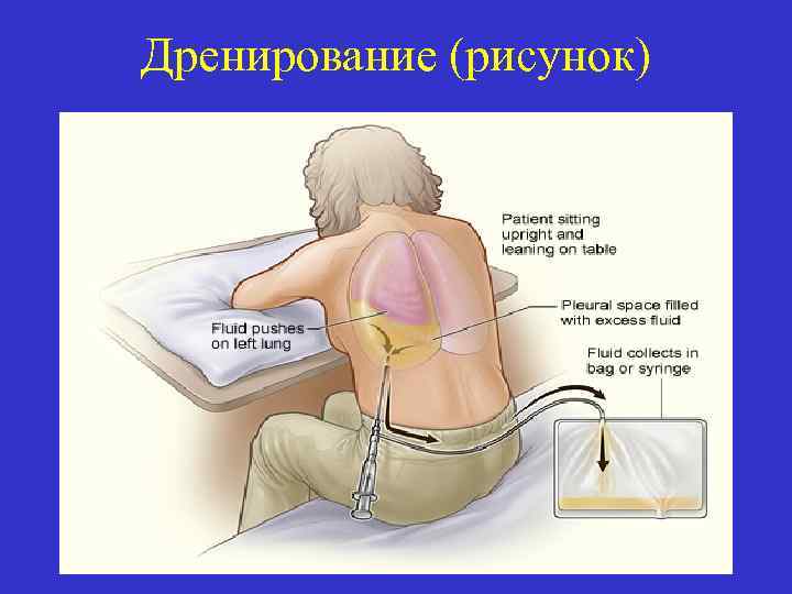 Дренирование (рисунок) 