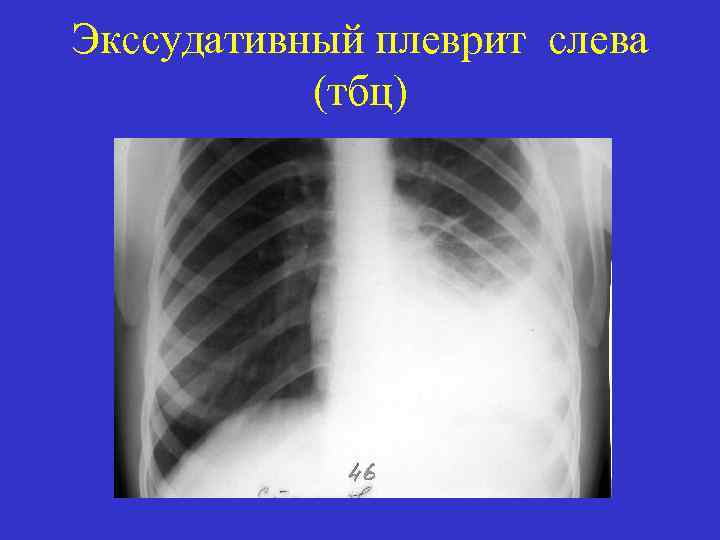 Экссудативный плеврит слева (тбц) 