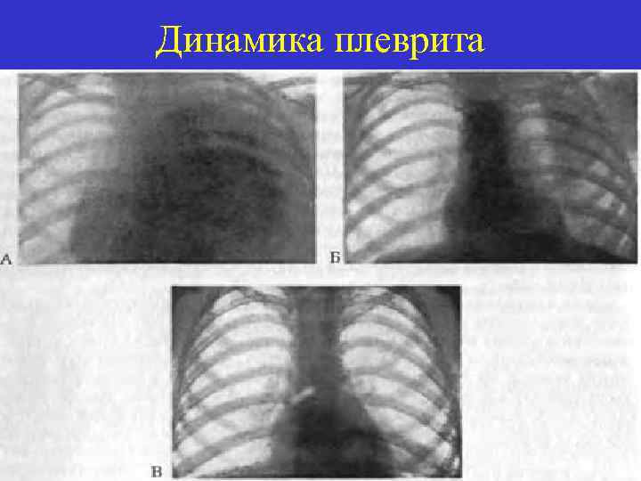 Динамика плеврита 