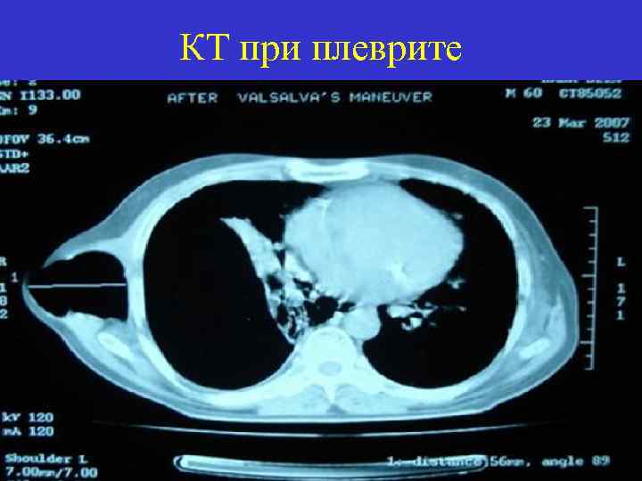 КТ при плеврите 