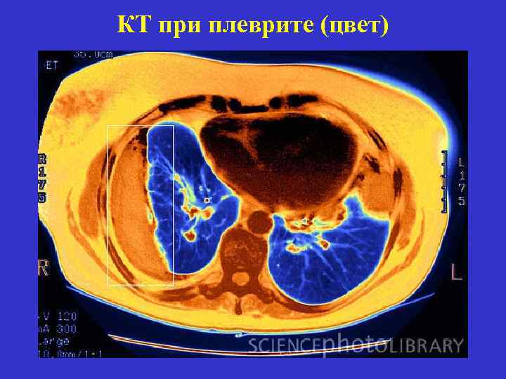 КТ при плеврите (цвет) 