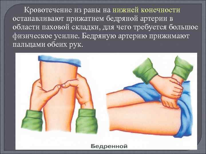 Кровотечение из раны на нижней конечности останавливают прижатием бедряной артерии в области паховой складки,