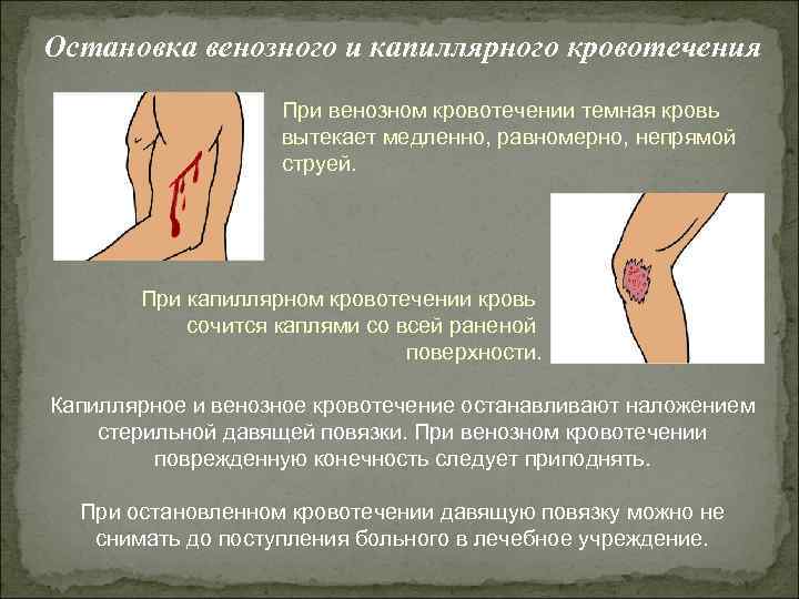 Остановка венозного и капиллярного кровотечения При венозном кровотечении темная кровь вытекает медленно, равномерно, непрямой