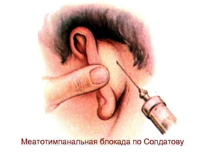 Меатотимпанальная блокада по Солдатову 