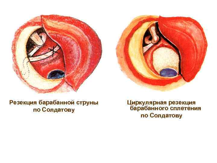 Резекция барабанной струны по Солдатову Циркулярная резекция барабанного сплетения по Солдатову 
