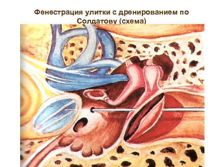 Фенестрация улитки с дренированием по Солдатову (схема) 