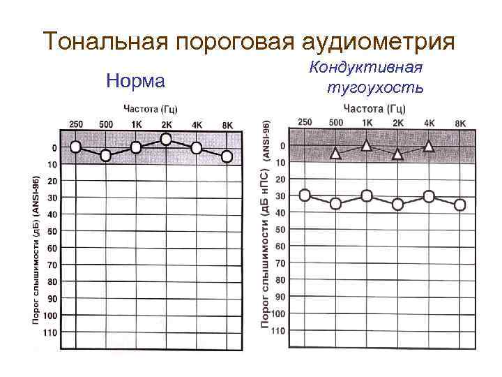 Тональная пороговая аудиометрия Норма Кондуктивная тугоухость 