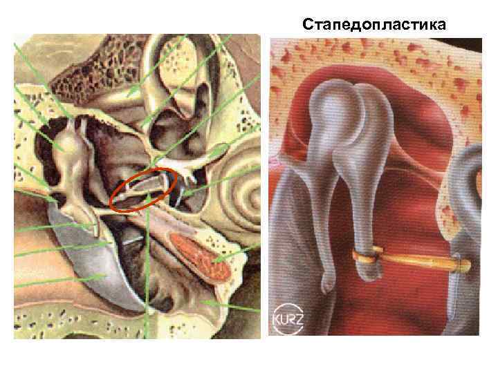Стапедопластика 