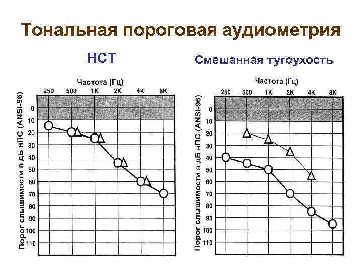 Тональная пороговая аудиометрия НСТ Смешанная тугоухость 